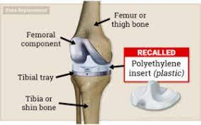 knee replacement recall capitelli wicker